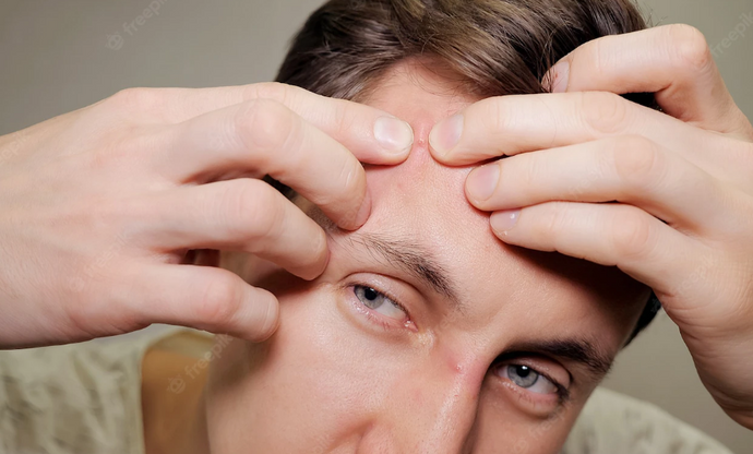 Los granos de tu rostro pueden ser señal de un problema de salud
