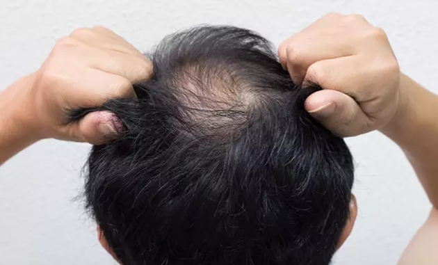5 consejos para combatir la caída de cabello